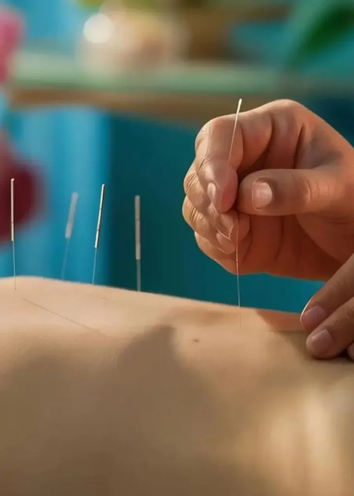 Acupuncture