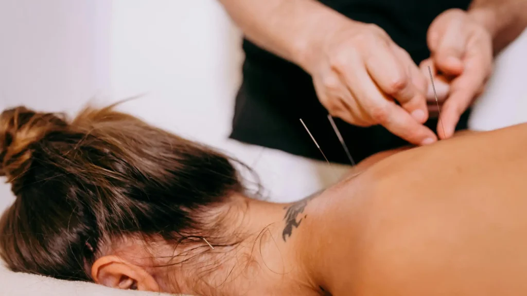 Acupuncture Langley treatment for pain relief at Restore Mobility Physiotherapy