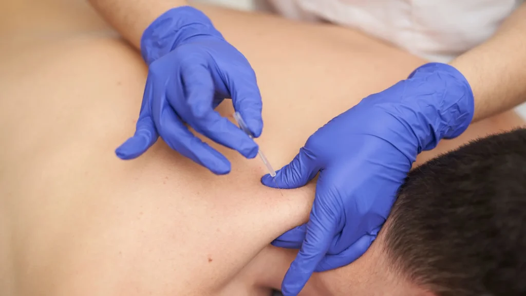 Dry Needling Langley IMS treatment session at Restore Mobility Physiotherapy